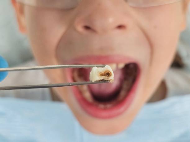 Best Emergency Broken Tooth Repair in Coos Bay, OR